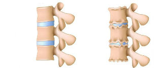 Osteochondrozės vystymosi mechanizmas