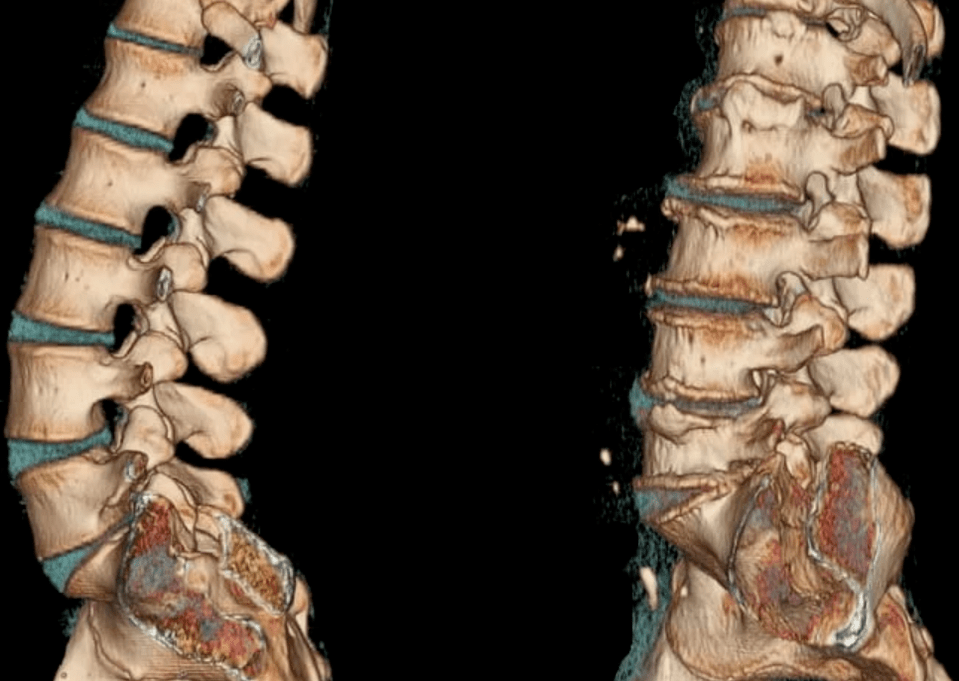 Osteochondrozė