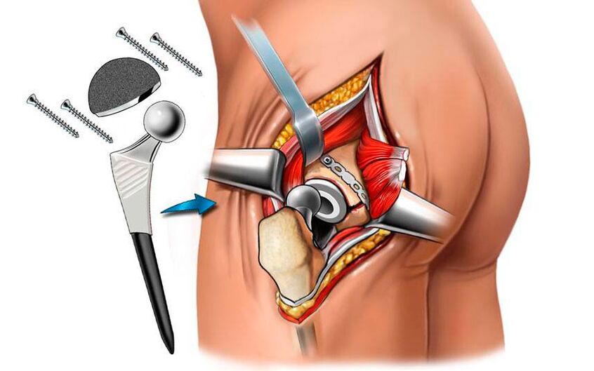 Endoprotezo montavimas – chirurginis koksartrozės problemos sprendimas