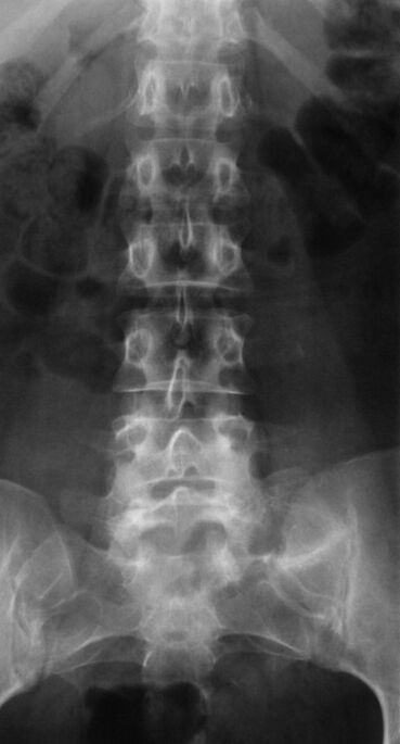 Juosmens osteochondrozei diagnozuoti atliekama rentgenografija