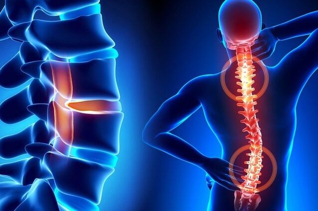 Stuburo osteochondrozė